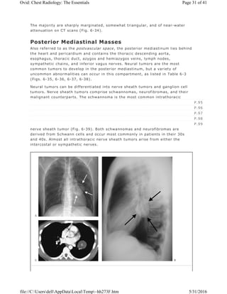 The majority are sharply marginated, somewhat triangular, and of near-water
attenuation on CT scans (Fig. 6-34).
Posterior Mediastinal Masses
Also referred to as the postvascular space, the posterior mediastinum lies behind
the heart and pericardium and contains the thoracic descending aorta,
esophagus, thoracic duct, azygos and hemiazygos veins, lymph nodes,
sympathetic chains, and inferior vagus nerves. Neural tumors are the most
common tumors to develop in the posterior mediastinum, but a variety of
uncommon abnormalities can occur in this compartment, as listed in Table 6-3
(Figs. 6-35, 6-36, 6-37, 6-38).
Neural tumors can be differentiated into nerve sheath tumors and ganglion cell
tumors. Nerve sheath tumors comprise schwannomas, neurofibromas, and their
malignant counterparts. The schwannoma is the most common intrathoracic
nerve sheath tumor (Fig. 6-39). Both schwannomas and neurofibromas are
derived from Schwann cells and occur most commonly in patients in their 30s
and 40s. Almost all intrathoracic nerve sheath tumors arise from either the
intercostal or sympathetic nerves.
P.95
P.96
P.97
P.98
P.99
Page 31 of 41Ovid: Chest Radiology: The Essentials
5/31/2016file://C:UsersdellAppDataLocalTemp~hh273F.htm
 