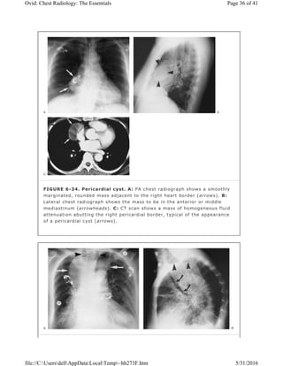 FIGURE 6-34. Pericardial cyst. A: PA chest radiograph shows a smoothly
marginated, rounded mass adjacent to the right heart border (arrows). B:
Lateral chest radiograph shows the mass to be in the anterior or middle
mediastinum (arrowheads). C: CT scan shows a mass of homogeneous fluid
attenuation abutting the right pericardial border, typical of the appearance
of a pericardial cyst (arrows).
Page 36 of 41Ovid: Chest Radiology: The Essentials
5/31/2016file://C:UsersdellAppDataLocalTemp~hh273F.htm
 