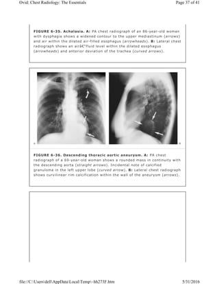 FIGURE 6-35. Achalasia. A: PA chest radiograph of an 86-year-old woman
with dysphagia shows a widened contour to the upper mediastinum (arrows)
and air within the dilated air-filled esophagus (arrowheads). B: Lateral chest
radiograph shows an airâ€“fluid level within the dilated esophagus
(arrowheads) and anterior deviation of the trachea (curved arrows).
FIGURE 6-36. Descending thoracic aortic aneurysm. A: PA chest
radiograph of a 69-year-old woman shows a rounded mass in continuity with
the descending aorta (straight arrows). Incidental note of calcified
granuloma in the left upper lobe (curved arrow). B: Lateral chest radiograph
shows curvilinear rim calcification within the wall of the aneurysm (arrows).
Page 37 of 41Ovid: Chest Radiology: The Essentials
5/31/2016file://C:UsersdellAppDataLocalTemp~hh273F.htm
 