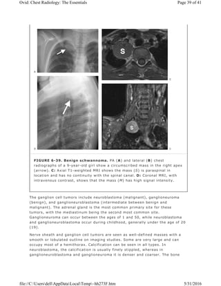 The ganglion cell tumors include neuroblastoma (malignant), ganglioneuroma
(benign), and ganglioneuroblastoma (intermediate between benign and
malignant). The adrenal gland is the most common primary site for these
tumors, with the mediastinum being the second most common site.
Ganglioneuroma can occur between the ages of 1 and 50, while neuroblastoma
and ganglioneuroblastoma occur during childhood, generally under the age of 20
(19).
Nerve sheath and ganglion cell tumors are seen as well-defined masses with a
smooth or lobulated outline on imaging studies. Some are very large and can
occupy most of a hemithorax. Calcification can be seen in all types. In
neuroblastoma, the calcification is usually finely stippled, whereas in
ganglioneuroblastoma and ganglioneuroma it is denser and coarser. The bone
FIGURE 6-39. Benign schwannoma. PA (A) and lateral (B) chest
radiographs of a 9-year-old girl show a circumscribed mass in the right apex
(arrow). C: Axial T1-weighted MRI shows the mass (S) is paraspinal in
location and has no continuity with the spinal canal. D: Coronal MRI, with
intravenous contrast, shows that the mass (M) has high signal intensity.
Page 39 of 41Ovid: Chest Radiology: The Essentials
5/31/2016file://C:UsersdellAppDataLocalTemp~hh273F.htm
 