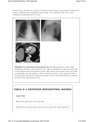 tumors (e.g., fibroma or lipoma), sternal tumor, primary lung tumor invading the
anterior mediastinum, Morgagni hernia (Fig. 6-4), abscess (Fig. 6-5), and
mediastinal lipomatosis (Fig. 6-6).
FIGURE 6-2. Prominent pericardial fat. A: Posteroanterior (PA) chest
radiograph shows a round mass at the right cardiophrenic angle (arrow) that
is less opaque than the adjacent heart. B: Lateral view shows that the mass
is projected over the anterior inferior heart (arrows) in the typical location
of pericardiac fat. C: CT shows this mass to be of fat attenuation (F), similar
to that of the subcutaneous fat.
TABLE 6-1 ANTERIOR MEDIASTINAL MASSES
â€œ4 Tsâ€
Thymoma (generally over age 40)
Teratoma (and other germ cell tumors, generally under age 40)
Page 4 of 41Ovid: Chest Radiology: The Essentials
5/31/2016file://C:UsersdellAppDataLocalTemp~hh273F.htm
 