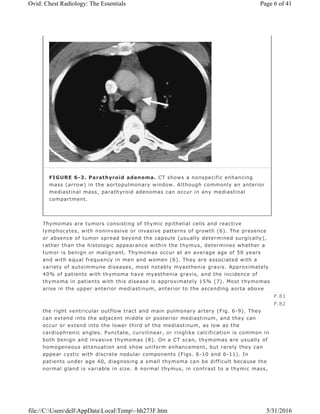 Thymomas are tumors consisting of thymic epithelial cells and reactive
lymphocytes, with noninvasive or invasive patterns of growth (6). The presence
or absence of tumor spread beyond the capsule (usually determined surgically),
rather than the histologic appearance within the thymus, determines whether a
tumor is benign or malignant. Thymomas occur at an average age of 50 years
and with equal frequency in men and women (6). They are associated with a
variety of autoimmune diseases, most notably myasthenia gravis. Approximately
40% of patients with thymoma have myasthenia gravis, and the incidence of
thymoma in patients with this disease is approximately 15% (7). Most thymomas
arise in the upper anterior mediastinum, anterior to the ascending aorta above
the right ventricular outflow tract and main pulmonary artery (Fig. 6-9). They
can extend into the adjacent middle or posterior mediastinum, and they can
occur or extend into the lower third of the mediastinum, as low as the
cardiophrenic angles. Punctate, curvilinear, or ringlike calcification is common in
both benign and invasive thymomas (8). On a CT scan, thymomas are usually of
homogeneous attenuation and show uniform enhancement, but rarely they can
appear cystic with discrete nodular components (Figs. 6-10 and 6-11). In
patients under age 40, diagnosing a small thymoma can be difficult because the
normal gland is variable in size. A normal thymus, in contrast to a thymic mass,
FIGURE 6-3. Parathyroid adenoma. CT shows a nonspecific enhancing
mass (arrow) in the aortopulmonary window. Although commonly an anterior
mediastinal mass, parathyroid adenomas can occur in any mediastinal
compartment.
P.81
P.82
Page 6 of 41Ovid: Chest Radiology: The Essentials
5/31/2016file://C:UsersdellAppDataLocalTemp~hh273F.htm
 