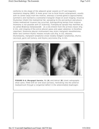 conforms to the shape of the adjacent great vessels on CT and magnetic
resonance imaging (MRI). A mass gives rise to focal thymic enlargement, usually
with its center away from the midline, whereas a normal gland is approximately
symmetric and maintains a somewhat triangular shape on axial imaging. Invasive
thymomas inhabit the mediastinal fat, spreading to the pericardium and pleura.
Unless mediastinal invasion has occurred, distinguishing benign from invasive
thymoma is not possible with CT scanning. Transpleural spread may manifest as
so-called â€œdrop metastasesâ€ at a site distant from the primary lesion (Fig.
6-12), and imaging of the entire pleural space and upper abdomen is therefore
important. Extensive pleural involvement may mimic malignant mesothelioma.
Other less common thymic masses include cyst (Fig. 6-13), abscess,
thymolipoma, malignant lymphoma (most notably Hodgkin lymphoma), thymic
carcinoid, germ cell tumors, and thymic carcinoma (Fig. 6-14).
FIGURE 6-4. Morgagni hernia. PA (A) and lateral (B) chest radiographs
show colon, filled with air and stool (arrows), herniating into the anterior
mediastinum through a congenital defect in the anteromedial diaphragm.
Page 7 of 41Ovid: Chest Radiology: The Essentials
5/31/2016file://C:UsersdellAppDataLocalTemp~hh273F.htm
 