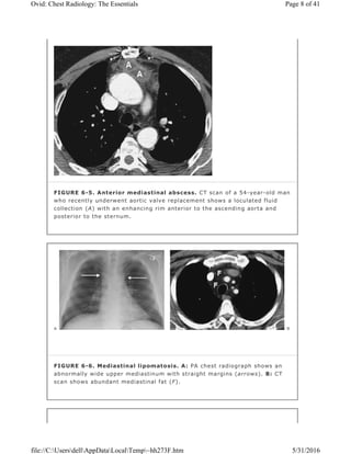 FIGURE 6-5. Anterior mediastinal abscess. CT scan of a 54-year-old man
who recently underwent aortic valve replacement shows a loculated fluid
collection (A) with an enhancing rim anterior to the ascending aorta and
posterior to the sternum.
FIGURE 6-6. Mediastinal lipomatosis. A: PA chest radiograph shows an
abnormally wide upper mediastinum with straight margins (arrows). B: CT
scan shows abundant mediastinal fat (F).
Page 8 of 41Ovid: Chest Radiology: The Essentials
5/31/2016file://C:UsersdellAppDataLocalTemp~hh273F.htm
 