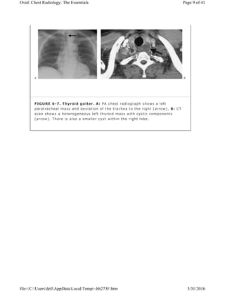 FIGURE 6-7. Thyroid goiter. A: PA chest radiograph shows a left
paratracheal mass and deviation of the trachea to the right (arrow). B: CT
scan shows a heterogeneous left thyroid mass with cystic components
(arrow). There is also a smaller cyst within the right lobe.
Page 9 of 41Ovid: Chest Radiology: The Essentials
5/31/2016file://C:UsersdellAppDataLocalTemp~hh273F.htm
 