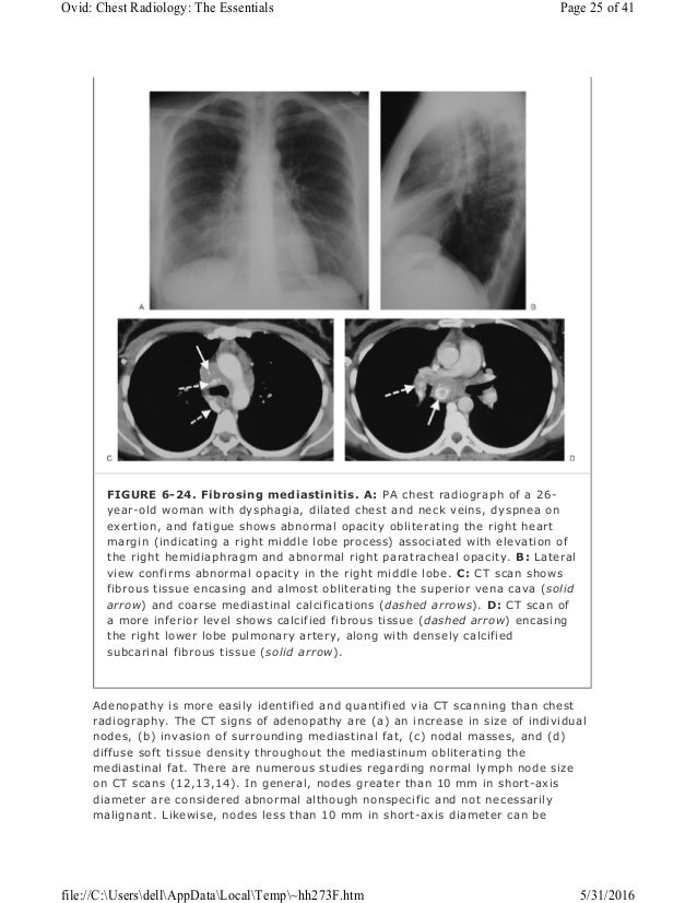 Chest radiology essentials mediastinal masses