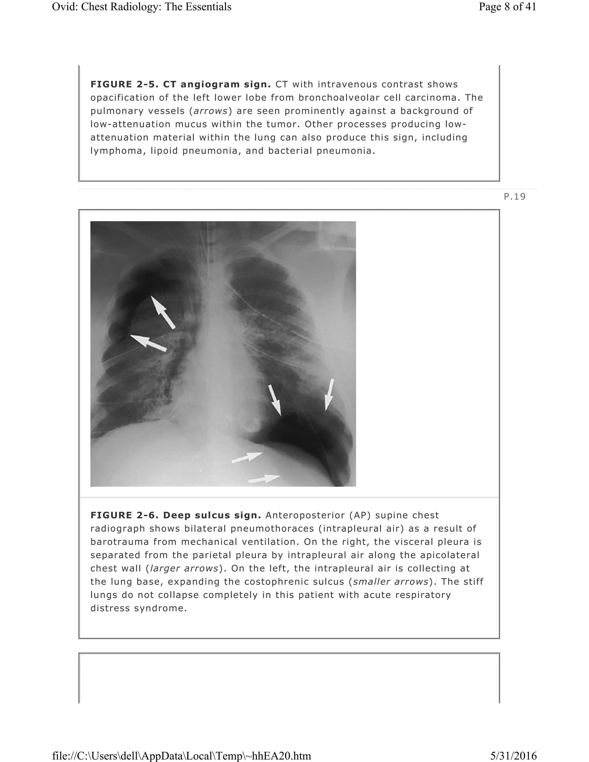 Chest radiology essentials signs | PDF