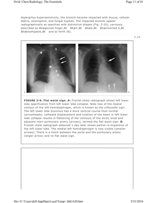 Aspergillus hypersensitivity, the bronchi become impacted with mucus, cellular
debris, eosinophils, and fungal hyphae. The impacted bronchi appear
radiographically as opacities with distinctive shapes (Fig. 2-10), variously
described as â€œgloved finger,â€ â€œY,â€ â€œV,â€ â€œinverted V,â€
â€œtoothpaste,â€ and so forth (8).
P.20
FIGURE 2-9. Flat waist sign. A: Frontal chest radiograph shows left lower
lobe opacification from left lower lobe collapse. Note loss of the medial
contour of the left hemidiaphragm, which is known as the silhouette sign.
The left lower lobe bronchus has a more vertical course than normal
(arrowheads). Leftward displacement and rotation of the heart in left lower
lobe collapse results in flattening of the contours of the aortic knob and
adjacent main pulmonary artery (arrows), termed the flat waist sign. B:
Frontal chest radiograph obtained 1 day later shows partial re-expansion of
the left lower lobe. The medial left hemidiaphragm is now visible (smaller
arrows). There is a notch between the aorta and the pulmonary artery
(larger arrow) and no flat waist sign.
Page 11 of 41Ovid: Chest Radiology: The Essentials
5/31/2016file://C:UsersdellAppDataLocalTemp~hhEA20.htm
 