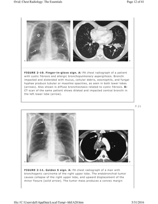 FIGURE 2-10. Finger-in-glove sign. A: PA chest radiograph of a patient
with cystic fibrosis and allergic bronchopulmonary aspergillosis. Bronchi
impacted and distended with mucus, cellular debris, eosinophils, and fungal
hyphae produce tubular or masslike opacities, as seen in both lower lobes
(arrows). Also shown is diffuse bronchiectasis related to cystic fibrosis. B:
CT scan of the same patient shows dilated and impacted central bronchi in
the left lower lobe (arrow).
P.21
FIGURE 2-11. Golden S sign. A: PA chest radiograph of a man with
bronchogenic carcinoma of the right upper lobe. The endobronchial tumor
causes collapse of the right upper lobe, and upward displacement of the
minor fissure (solid arrow). The tumor mass produces a convex margin
Page 12 of 41Ovid: Chest Radiology: The Essentials
5/31/2016file://C:UsersdellAppDataLocalTemp~hhEA20.htm
 