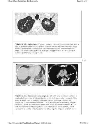 FIGURE 2-12. Halo sign. CT shows nodular consolidation associated with a
halo of ground-glass opacity (GGO) in both apices (arrows) resulting from
invasive pulmonary aspergillosis. This halo represents hemorrhage and,
when seen in leukemic patients, is highly suggestive of the diagnosis of
invasive pulmonary aspergillosis.
P.22
FIGURE 2-13. Hampton hump sign. A: CT with lung windowing shows a
focal subpleural area of consolidation in the left lower lobe (arrows). This
hump-shaped area of opacification represents pulmonary infarction
secondary to pulmonary embolism. There are also small bilateral pleural
effusions, which are commonly seen with acute pulmonary emboli. B: CT
with mediastinal windowing shows low-attenuation filling defect, which
represents a saddle embolus (arrows) bridging the lingular and left lower
Page 14 of 41Ovid: Chest Radiology: The Essentials
5/31/2016file://C:UsersdellAppDataLocalTemp~hhEA20.htm
 
