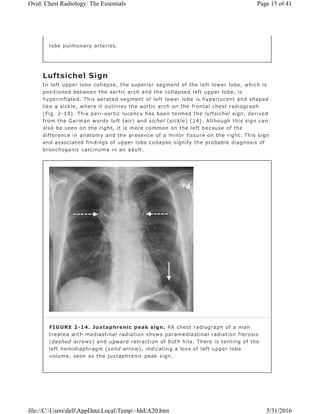 Luftsichel Sign
In left upper lobe collapse, the superior segment of the left lower lobe, which is
positioned between the aortic arch and the collapsed left upper lobe, is
hyperinflated. This aerated segment of left lower lobe is hyperlucent and shaped
like a sickle, where it outlines the aortic arch on the frontal chest radiograph
(Fig. 2-15). This peri-aortic lucency has been termed the luftsichel sign, derived
from the German words luft (air) and sichel (sickle) (14). Although this sign can
also be seen on the right, it is more common on the left because of the
difference in anatomy and the presence of a minor fissure on the right. This sign
and associated findings of upper lobe collapse signify the probable diagnosis of
bronchogenic carcinoma in an adult.
lobe pulmonary arteries.
FIGURE 2-14. Juxtaphrenic peak sign. PA chest radiograph of a man
treated with mediastinal radiation shows paramediastinal radiation fibrosis
(dashed arrows) and upward retraction of both hila. There is tenting of the
left hemidiaphragm (solid arrow), indicating a loss of left upper lobe
volume, seen as the juxtaphrenic peak sign.
Page 15 of 41Ovid: Chest Radiology: The Essentials
5/31/2016file://C:UsersdellAppDataLocalTemp~hhEA20.htm
 