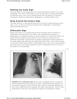 Melting Ice Cube Sign
This sign refers to the appearance of a resolving pulmonary infarct on a chest
radiograph or CT scan, which looks like an ice cube that is melting peripherally
to internally (Fig. 2-16). This is distinguished from the pattern of resolving
pneumonia, where the opacification disappears in a patchy fashion (15).
Ring Around the Artery Sign
This sign refers to a well-defined lucency encircling the right pulmonary artery
(Fig. 2-17), as seen on frontal and lateral chest radiographs, representing
pneumomediastinum (16).
Silhouette Sign
Felson and Felson (17) popularized the term silhouette sign to indicate an
obliteration of the borders of the heart, other mediastinal structures, or
diaphragm by an adjacent opacity of similar density. An intrathoracic lesion not
anatomically contiguous with a border of one of these structures will not
obliterate that border. Parenchymal processes involving the medial segment of
the right middle lobe obliterate the right heart border (Fig. 2-18). If the lingula
is involved, the left heart border is obliterated (Fig. 2-19). Lower lobe processes
involving one or more basilar segments result in obliteration of all or a part of
the border of the diaphragm.
P.23
FIGURE 2-15. Luftsichel sign. A: PA chest radiograph shows a crescentic
lucency adjacent to the aortic arch (arrows), representing hyperaeration of
the superior segment of the left lower lobe, which is positioned between the
aortic arch medially and the collapsed left upper lobe laterally. There is hazy
opacification of the left lung (sparing the apex and costophrenic angle),
Page 16 of 41Ovid: Chest Radiology: The Essentials
5/31/2016file://C:UsersdellAppDataLocalTemp~hhEA20.htm
 