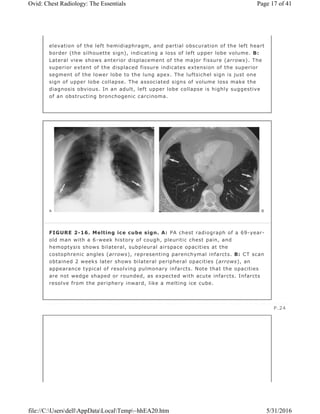 elevation of the left hemidiaphragm, and partial obscuration of the left heart
border (the silhouette sign), indicating a loss of left upper lobe volume. B:
Lateral view shows anterior displacement of the major fissure (arrows). The
superior extent of the displaced fissure indicates extension of the superior
segment of the lower lobe to the lung apex. The luftsichel sign is just one
sign of upper lobe collapse. The associated signs of volume loss make the
diagnosis obvious. In an adult, left upper lobe collapse is highly suggestive
of an obstructing bronchogenic carcinoma.
FIGURE 2-16. Melting ice cube sign. A: PA chest radiograph of a 69-year-
old man with a 6-week history of cough, pleuritic chest pain, and
hemoptysis shows bilateral, subpleural airspace opacities at the
costophrenic angles (arrows), representing parenchymal infarcts. B: CT scan
obtained 2 weeks later shows bilateral peripheral opacities (arrows), an
appearance typical of resolving pulmonary infarcts. Note that the opacities
are not wedge shaped or rounded, as expected with acute infarcts. Infarcts
resolve from the periphery inward, like a melting ice cube.
P.24
Page 17 of 41Ovid: Chest Radiology: The Essentials
5/31/2016file://C:UsersdellAppDataLocalTemp~hhEA20.htm
 