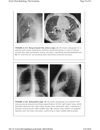 FIGURE 2-17. Ring around the artery sign. A: PA chest radiograph of a
patient with acute respiratory distress syndrome shows a ring of lucency
around the right pulmonary artery (arrows), signifying pneumomediastinum.
B: CT confirms air surrounding both pulmonary arteries (arrows).
FIGURE 2-18. Silhouette sign. A: PA chest radiograph of a patient with
pneumococcal pneumonia shows opacification of the right lower lung, which
partially obscures the right heart border (the silhouette sign), indicating a
process involving the right middle lobe. B: Lateral view shows a triangular
opacity over the heart (arrows), confirming a right middle lobe process.
Page 18 of 41Ovid: Chest Radiology: The Essentials
5/31/2016file://C:UsersdellAppDataLocalTemp~hhEA20.htm
 