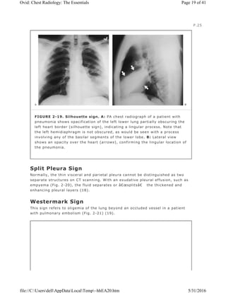Split Pleura Sign
Normally, the thin visceral and parietal pleura cannot be distinguished as two
separate structures on CT scanning. With an exudative pleural effusion, such as
empyema (Fig. 2-20), the fluid separates or â€œsplitsâ€ the thickened and
enhancing pleural layers (18).
Westermark Sign
This sign refers to oligemia of the lung beyond an occluded vessel in a patient
with pulmonary embolism (Fig. 2-21) (19).
P.25
FIGURE 2-19. Silhouette sign. A: PA chest radiograph of a patient with
pneumonia shows opacification of the left lower lung partially obscuring the
left heart border (silhouette sign), indicating a lingular process. Note that
the left hemidiaphragm is not obscured, as would be seen with a process
involving any of the basilar segments of the lower lobe. B: Lateral view
shows an opacity over the heart (arrows), confirming the lingular location of
the pneumonia.
Page 19 of 41Ovid: Chest Radiology: The Essentials
5/31/2016file://C:UsersdellAppDataLocalTemp~hhEA20.htm
 