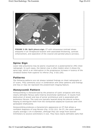 Spine Sign
Lower lobe pneumonia may be poorly visualized on a posteroanterior (PA) chest
radiograph. In such cases, the lateral view is often helpful when it shows the
spine sign, which is an interruption in the progressive increase in lucency of the
vertebral bodies from superior to inferior (Fig. 2-22) (20).
Patterns
The following patterns are not always isolated findings on chest radiographs or
CT scans. They commonly occur in combination with other patterns and findings
and may or may not represent the predominant imaging feature.
Honeycomb Pattern
Honeycombing is characterized by the presence of cystic airspaces with thick,
clearly definable fibrous walls lined by bronchiolar epithelium. It results from
destruction of alveoli and loss of acinar architecture and is associated with
pulmonary fibrosis. The cysts are typically layered along the pleural surface,
helping to distinguish them from the nonlayered subpleural lucencies seen with
paraseptal emphysema.
Honeycombing produces a characteristic appearance on CT that allows a
confident diagnosis of lung fibrosis (Fig. 2-23) (21). On CT, the cystic spaces
usually average 1 cm in diameter, although they can range from several
millimeters to several centimeters in size. They have clearly definable walls that
FIGURE 2-20. Split pleura sign. CT with intravenous contrast shows
empyema in an intrapleural location with associated thickening, contrast
enhancement, and separation of the visceral and parietal pleura (arrows).
Page 20 of 41Ovid: Chest Radiology: The Essentials
5/31/2016file://C:UsersdellAppDataLocalTemp~hhEA20.htm
 