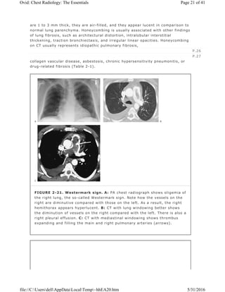 are 1 to 3 mm thick, they are air-filled, and they appear lucent in comparison to
normal lung parenchyma. Honeycombing is usually associated with other findings
of lung fibrosis, such as architectural distortion, intralobular interstitial
thickening, traction bronchiectasis, and irregular linear opacities. Honeycombing
on CT usually represents idiopathic pulmonary fibrosis,
collagen vascular disease, asbestosis, chronic hypersensitivity pneumonitis, or
drug-related fibrosis (Table 2-1).
P.26
P.27
FIGURE 2-21. Westermark sign. A: PA chest radiograph shows oligemia of
the right lung, the so-called Westermark sign. Note how the vessels on the
right are diminutive compared with those on the left. As a result, the right
hemithorax appears hyperlucent. B: CT with lung windowing better shows
the diminution of vessels on the right compared with the left. There is also a
right pleural effusion. C: CT with mediastinal windowing shows thrombus
expanding and filling the main and right pulmonary arteries (arrows).
Page 21 of 41Ovid: Chest Radiology: The Essentials
5/31/2016file://C:UsersdellAppDataLocalTemp~hhEA20.htm
 
