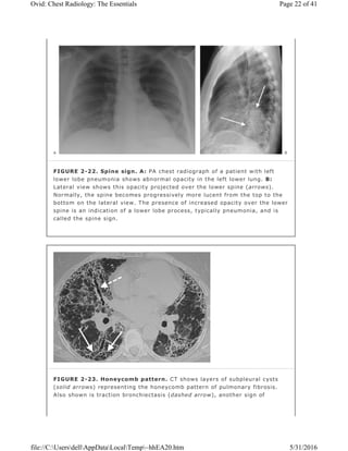 FIGURE 2-22. Spine sign. A: PA chest radiograph of a patient with left
lower lobe pneumonia shows abnormal opacity in the left lower lung. B:
Lateral view shows this opacity projected over the lower spine (arrows).
Normally, the spine becomes progressively more lucent from the top to the
bottom on the lateral view. The presence of increased opacity over the lower
spine is an indication of a lower lobe process, typically pneumonia, and is
called the spine sign.
FIGURE 2-23. Honeycomb pattern. CT shows layers of subpleural cysts
(solid arrows) representing the honeycomb pattern of pulmonary fibrosis.
Also shown is traction bronchiectasis (dashed arrow), another sign of
Page 22 of 41Ovid: Chest Radiology: The Essentials
5/31/2016file://C:UsersdellAppDataLocalTemp~hhEA20.htm
 