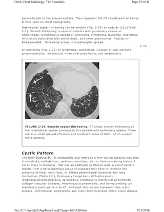 perpendicular to the pleural surface. They represent the CT counterpart of Kerley
B lines seen on chest radiographs.
Interlobular septal thickening can be smooth (Fig. 2-24) or nodular (22) (Table
2-1). Smooth thickening is seen in patients with pulmonary edema or
hemorrhage, lymphangitic spread of carcinoma, lymphoma, leukemia, interstitial
infiltration associated with amyloidosis, and some pneumonias. Nodular or
â€œbeadedâ€ thickening occurs in lymphangitic spread
of carcinoma (Fig. 2-25) or lymphoma, sarcoidosis, silicosis or coal worker's
pneumoconiosis, lymphocytic interstitial pneumonia, and amyloidosis.
Cystic Pattern
The term â€œcystâ€ is nonspecific and refers to a thin-walled (usually less than
3 mm thick), well-defined, well-circumscribed, air- or fluid-containing lesion, 1
cm or more in diameter, that has an epithelial or fibrous wall. A cystic pattern
results from a heterogeneous group of diseases that have in common the
presence of focal, multifocal, or diffuse parenchymal lucencies and lung
destruction (Table 2-1). Pulmonary Langerhan cell histiocytosis,
lymphangioleiomyomatosis, sarcoidosis, lymphocytic interstitial pneumonitis,
collagen vascular diseases, Pneumocystis pneumonia, and honeycombing can
manifest a cystic pattern on CT. Although they do not represent true cystic
disease, centrilobular emphysema and cystic bronchiectasis mimic cystic disease
P.28
FIGURE 2-24. Smooth septal thickening. CT shows smooth thickening of
the interlobular septae (arrows) in this patient with pulmonary edema. There
are also small pleural effusions and scattered areas of GGO, which support
the diagnosis.
Page 25 of 41Ovid: Chest Radiology: The Essentials
5/31/2016file://C:UsersdellAppDataLocalTemp~hhEA20.htm
 