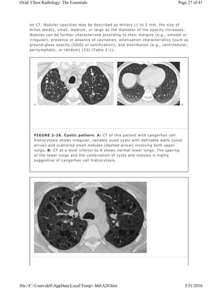 on CT. Nodular opacities may be described as miliary (1 to 2 mm, the size of
millet seeds), small, medium, or large as the diameter of the opacity increases.
Nodules can be further characterized according to their margins (e.g., smooth or
irregular), presence or absence of cavitation, attenuation characteristics (such as
ground-glass opacity [GGO] or calcification), and distribution (e.g., centrilobular,
perilymphatic, or random) (23) (Table 2-1).
FIGURE 2-26. Cystic pattern. A: CT of this patient with Langerhan cell
histiocytosis shows irregular, variably sized cysts with definable walls (solid
arrow) and scattered small nodules (dashed arrow) involving both upper
lungs. B: CT at a level inferior to A shows normal lower lungs. The sparing
of the lower lungs and the combination of cysts and nodules is highly
suggestive of Langerhan cell histiocytosis.
Page 27 of 41Ovid: Chest Radiology: The Essentials
5/31/2016file://C:UsersdellAppDataLocalTemp~hhEA20.htm
 