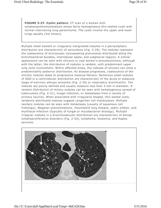 Multiple small smooth or irregularly marginated nodules in a perilymphatic
distribution are characteristic of sarcoidosis (Fig. 2-29). The nodules represent
the coalescence of microscopic noncaseating granulomas distributed along the
bronchoarterial bundles, interlobular septa, and subpleural regions. A similar
appearance can be seen with silicosis or coal worker's pneumoconiosis, although
with the latter, the distribution of nodules is random, with predominant upper
lung zone involvement. Within affected areas, the nodules of silicosis can show a
predominantly posterior distribution. As disease progresses, coalescence of the
silicotic nodules leads to progressive massive fibrosis. Numerous small nodules
of GGO in a centrilobular distribution are characteristic of the acute or subacute
stage of extrinsic allergic alveolitis (Fig. 2-30) or respiratory bronchiolitis. The
nodules are poorly defined and usually measure less than 3 mm in diameter. A
random distribution of miliary nodules can be seen with hematogenous spread of
tuberculosis (Fig. 2-31), fungal infection, or metastases from a variety of
primary sources. When associated with irregularly shaped, thin-walled cysts,
randomly distributed nodules suggest Langerhan cell histiocytosis. Multiple
cavitary nodules can be seen with metastases (usually of squamous cell
histology), Wegener granulomatosis, rheumatoid lung disease, septic emboli, and
multifocal infection (typically of fungal or mycobacterial etiology). Multiple
irregular nodules in a bronchovascular distribution are characteristic of benign
lymphoproliferative disorders (Fig. 2-32), lymphoma, leukemia, and Kaposi
sarcoma.
FIGURE 2-27. Cystic pattern. CT scan of a woman with
lymphangioleiomyomatosis shows fairly homogeneous thin-walled cysts with
normal intervening lung parenchyma. The cysts involve the upper and lower
lungs equally (not shown).
Page 28 of 41Ovid: Chest Radiology: The Essentials
5/31/2016file://C:UsersdellAppDataLocalTemp~hhEA20.htm
 