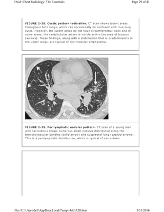 FIGURE 2-28. Cystic pattern look-alike. CT scan shows lucent areas
throughout both lungs, which can occasionally be confused with true lung
cysts. However, the lucent areas do not have circumferential walls and in
some areas, the centrilobular artery is visible within the area of lucency
(arrows). These findings, along with a distribution that is predominantly in
the upper lungs, are typical of centrilobular emphysema.
FIGURE 2-29. Perilymphatic nodular pattern. CT scan of a young man
with sarcoidosis shows numerous small nodules distributed along the
bronchovascular bundles (solid arrow) and subpleural lung (dashed arrows).
This is a perilymphatic distribution, which is typical of sarcoidosis.
Page 29 of 41Ovid: Chest Radiology: The Essentials
5/31/2016file://C:UsersdellAppDataLocalTemp~hhEA20.htm
 