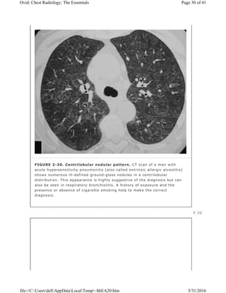 FIGURE 2-30. Centrilobular nodular pattern. CT scan of a man with
acute hypersensitivity pneumonitis (also called extrinsic allergic alveolitis)
shows numerous ill-defined ground-glass nodules in a centrilobular
distribution. This appearance is highly suggestive of the diagnosis but can
also be seen in respiratory bronchiolitis. A history of exposure and the
presence or absence of cigarette smoking help to make the correct
diagnosis.
P.30
Page 30 of 41Ovid: Chest Radiology: The Essentials
5/31/2016file://C:UsersdellAppDataLocalTemp~hhEA20.htm
 