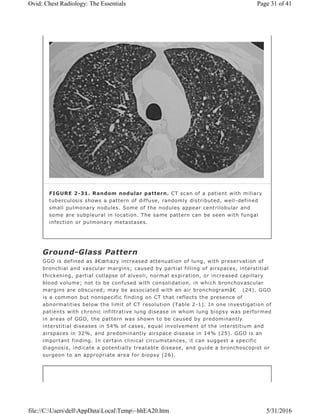 Ground-Glass Pattern
GGO is defined as â€œhazy increased attenuation of lung, with preservation of
bronchial and vascular margins; caused by partial filling of airspaces, interstitial
thickening, partial collapse of alveoli, normal expiration, or increased capillary
blood volume; not to be confused with consolidation, in which bronchovascular
margins are obscured; may be associated with an air bronchogramâ€ (24). GGO
is a common but nonspecific finding on CT that reflects the presence of
abnormalities below the limit of CT resolution (Table 2-1). In one investigation of
patients with chronic infiltrative lung disease in whom lung biopsy was performed
in areas of GGO, the pattern was shown to be caused by predominantly
interstitial diseases in 54% of cases, equal involvement of the interstitium and
airspaces in 32%, and predominantly airspace disease in 14% (25). GGO is an
important finding. In certain clinical circumstances, it can suggest a specific
diagnosis, indicate a potentially treatable disease, and guide a bronchoscopist or
surgeon to an appropriate area for biopsy (26).
FIGURE 2-31. Random nodular pattern. CT scan of a patient with miliary
tuberculosis shows a pattern of diffuse, randomly distributed, well-defined
small pulmonary nodules. Some of the nodules appear centrilobular and
some are subpleural in location. The same pattern can be seen with fungal
infection or pulmonary metastases.
Page 31 of 41Ovid: Chest Radiology: The Essentials
5/31/2016file://C:UsersdellAppDataLocalTemp~hhEA20.htm
 