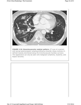 FIGURE 2-32. Bronchovascular nodular pattern. CT scan of a patient
with benign posttransplant lymphoproliferative disorder shows multiple ill-
defined nodules distributed along the bronchovascular bundles (arrows).
This appearance can also be seen with malignant lymphoma, leukemia, and
Kaposi sarcoma.
Page 32 of 41Ovid: Chest Radiology: The Essentials
5/31/2016file://C:UsersdellAppDataLocalTemp~hhEA20.htm
 
