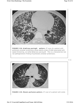 FIGURE 2-34. â€œCrazy pavingâ€ pattern. CT scan of a patient with
pulmonary alveolar proteinosis shows patchy areas of GGO associated with
septal thickening, so-called â€œcrazy paving.â€ This is a characteristic but
not pathognomonic finding of pulmonary alveolar proteinosis.
P.31
FIGURE 2-35. Mosaic perfusion pattern. CT scan of a patient with sickle
Page 34 of 41Ovid: Chest Radiology: The Essentials
5/31/2016file://C:UsersdellAppDataLocalTemp~hhEA20.htm
 