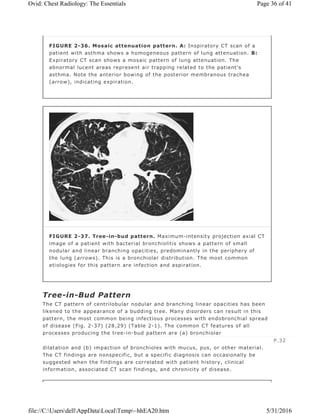 Tree-in-Bud Pattern
The CT pattern of centrilobular nodular and branching linear opacities has been
likened to the appearance of a budding tree. Many disorders can result in this
pattern, the most common being infectious processes with endobronchial spread
of disease (Fig. 2-37) (28,29) (Table 2-1). The common CT features of all
processes producing the tree-in-bud pattern are (a) bronchiolar
dilatation and (b) impaction of bronchioles with mucus, pus, or other material.
The CT findings are nonspecific, but a specific diagnosis can occasionally be
suggested when the findings are correlated with patient history, clinical
information, associated CT scan findings, and chronicity of disease.
FIGURE 2-36. Mosaic attenuation pattern. A: Inspiratory CT scan of a
patient with asthma shows a homogeneous pattern of lung attenuation. B:
Expiratory CT scan shows a mosaic pattern of lung attenuation. The
abnormal lucent areas represent air trapping related to the patient's
asthma. Note the anterior bowing of the posterior membranous trachea
(arrow), indicating expiration.
FIGURE 2-37. Tree-in-bud pattern. Maximum-intensity projection axial CT
image of a patient with bacterial bronchiolitis shows a pattern of small
nodular and linear branching opacities, predominantly in the periphery of
the lung (arrows). This is a bronchiolar distribution. The most common
etiologies for this pattern are infection and aspiration.
P.32
Page 36 of 41Ovid: Chest Radiology: The Essentials
5/31/2016file://C:UsersdellAppDataLocalTemp~hhEA20.htm
 