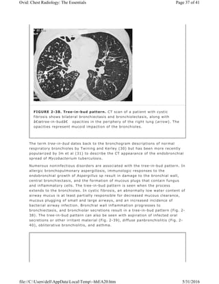 The term tree-in-bud dates back to the bronchogram descriptions of normal
respiratory bronchioles by Twining and Kerley (30) but has been more recently
popularized by Im et al (31) to describe the CT appearance of the endobronchial
spread of Mycobacterium tuberculosis.
Numerous noninfectious disorders are associated with the tree-in-bud pattern. In
allergic bronchopulmonary aspergillosis, immunologic responses to the
endobronchial growth of Aspergillus sp result in damage to the bronchial wall,
central bronchiectasis, and the formation of mucous plugs that contain fungus
and inflammatory cells. The tree-in-bud pattern is seen when the process
extends to the bronchioles. In cystic fibrosis, an abnormally low water content of
airway mucus is at least partially responsible for decreased mucous clearance,
mucous plugging of small and large airways, and an increased incidence of
bacterial airway infection. Bronchial wall inflammation progresses to
bronchiectasis, and bronchiolar secretions result in a tree-in-bud pattern (Fig. 2-
38). The tree-in-bud pattern can also be seen with aspiration of infected oral
secretions or other irritant material (Fig. 2-39), diffuse panbronchiolitis (Fig. 2-
40), obliterative bronchiolitis, and asthma.
FIGURE 2-38. Tree-in-bud pattern. CT scan of a patient with cystic
fibrosis shows bilateral bronchiectasis and bronchiolectasis, along with
â€œtree-in-budâ€ opacities in the periphery of the right lung (arrow). The
opacities represent mucoid impaction of the bronchioles.
Page 37 of 41Ovid: Chest Radiology: The Essentials
5/31/2016file://C:UsersdellAppDataLocalTemp~hhEA20.htm
 