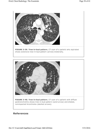 References
FIGURE 2-39. Tree-in-bud pattern. CT scan of a patient who aspirated
shows extensive tree-in-bud pattern (arrow) bilaterally.
FIGURE 2-40. Tree-in-bud pattern. CT scan of a patient with diffuse
panbronchiolitis shows tree-in-bud pattern (solid arrow) and dilated,
nonimpacted bronchioles (dashed arrows).
Page 38 of 41Ovid: Chest Radiology: The Essentials
5/31/2016file://C:UsersdellAppDataLocalTemp~hhEA20.htm
 
