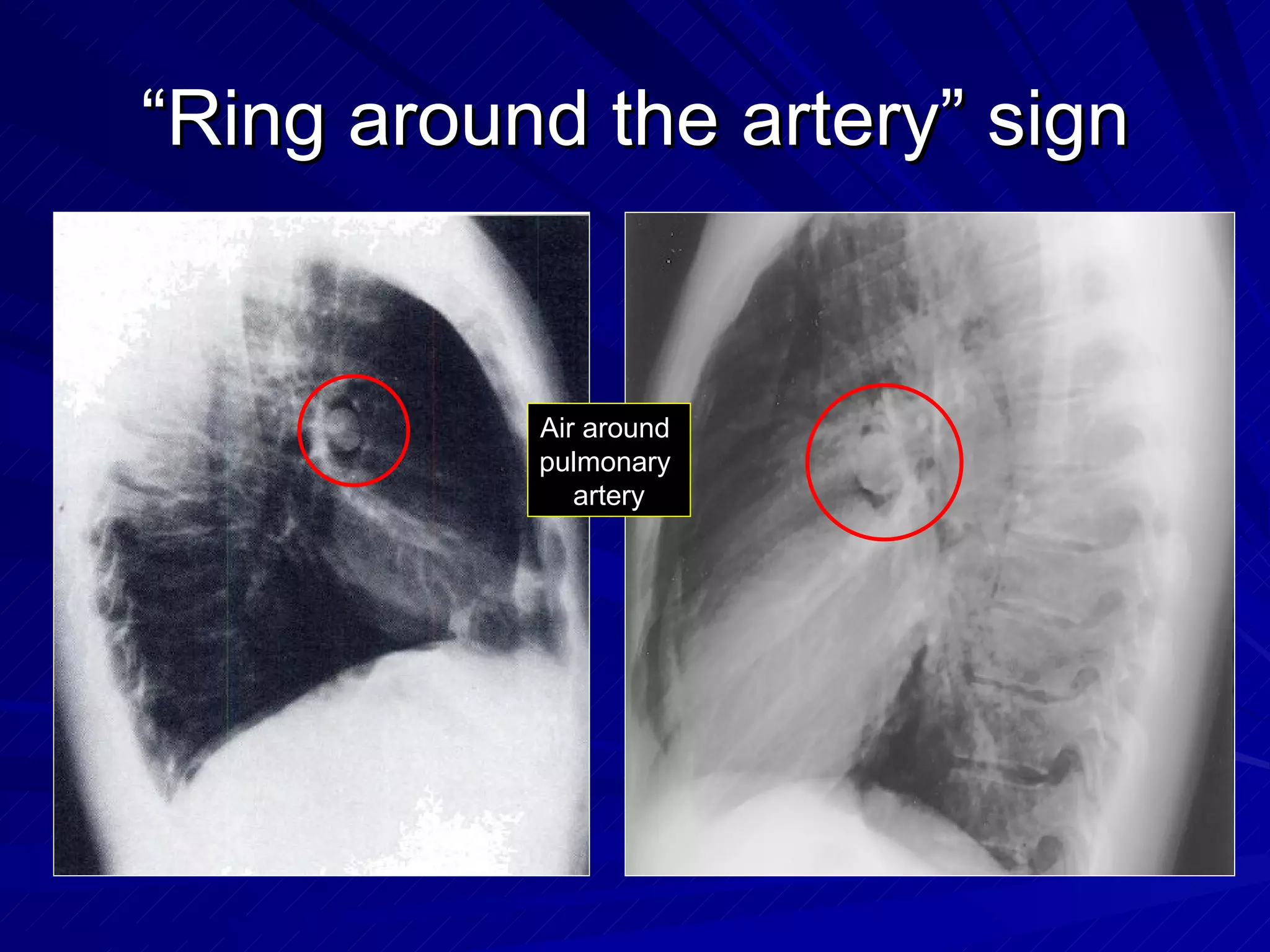 Chest radiology in intensive care | PPT