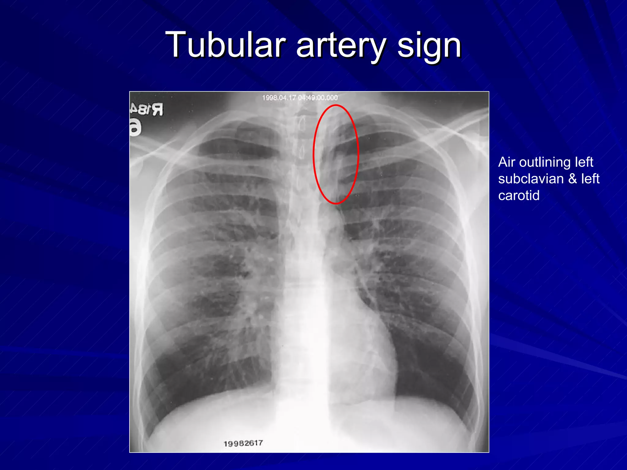 Chest radiology in intensive care | PPT
