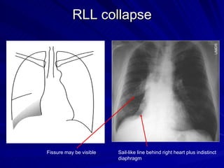 Rml Collapse Radiograph Chest radiology in intensive care | PPT