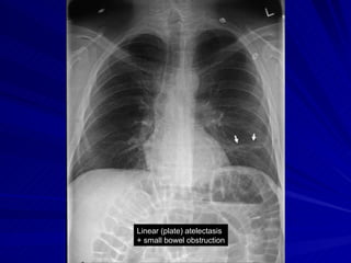 Plate Obstructer Chest radiology in intensive care | PPT