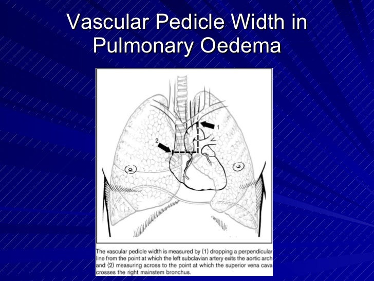 Chest radiology in intensive care