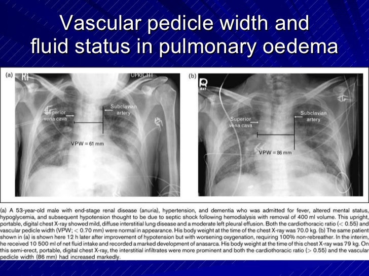 Chest radiology in intensive care