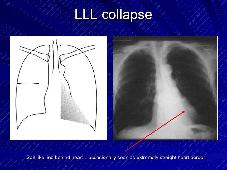 Chest radiology in intensive care