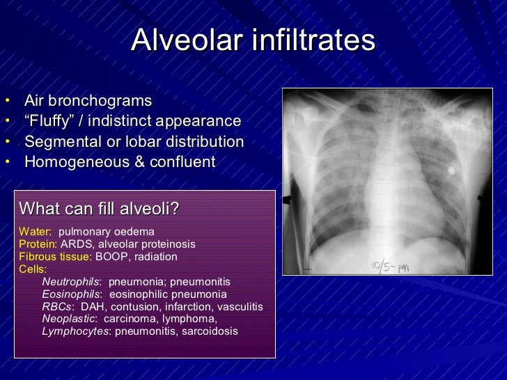 Chest radiology in intensive care