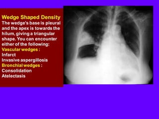 Wedge Shape Triangular Base Chest radiology part 1 | PDF