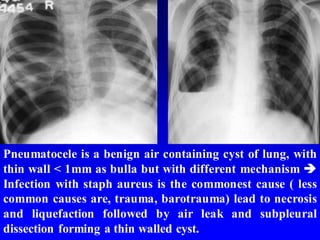 Pneumatocele is a benign air containing cyst of lung, with
thin wall < 1mm as bulla but with different mechanism 
Infection with staph aureus is the commonest cause ( less
common causes are, trauma, barotrauma) lead to necrosis
and liquefaction followed by air leak and subpleural
dissection forming a thin walled cyst.
 