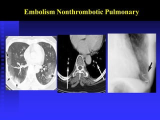 Embolism Nonthrombotic Pulmonary
 