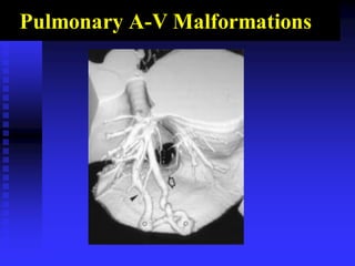 Pulmonary A-V Malformations
 