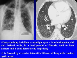 •Honeycombing is defined as multiple cysts < 1cm in diameter,with
well defined walls, in a background of fibrosis, tend to form
clusters and is considered as end stage lung .
•It is formed by extensive interstitial fibrosis of lung with residual
cystic areas.
 
