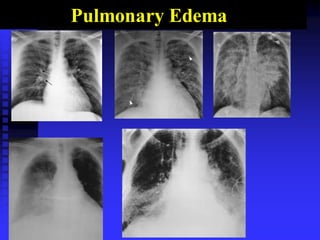 Pulmonary Edema
 