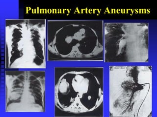 Pulmonary Artery Aneurysms
 