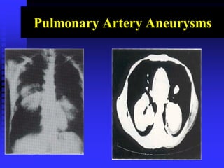 Pulmonary Artery Aneurysms
 
