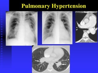 Pulmonary Hypertension
 